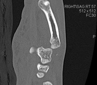 Base of Metacarpal Dislocation CT